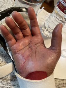 Picture of scarred hand healing from surgery
